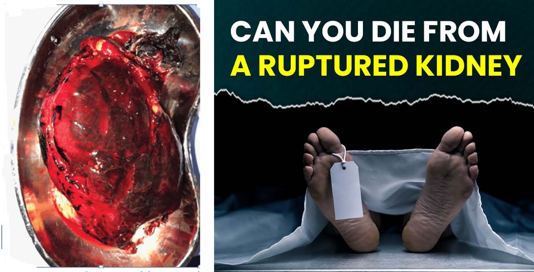 Can a Ruptured Kidney Kill You?